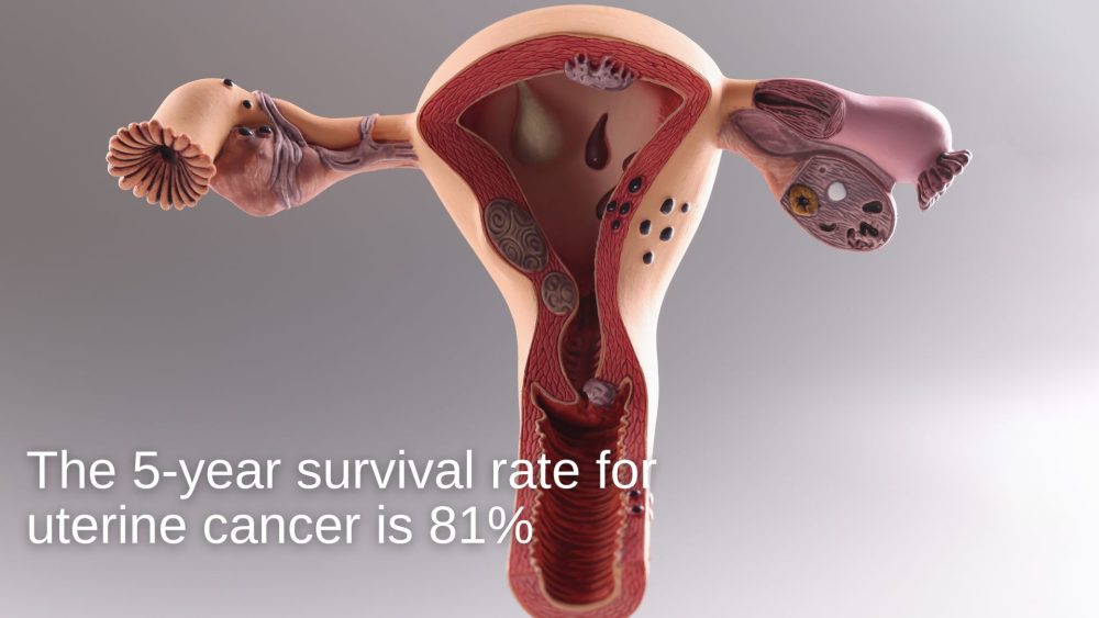 uterine-cancer-related-personal-injury-claims